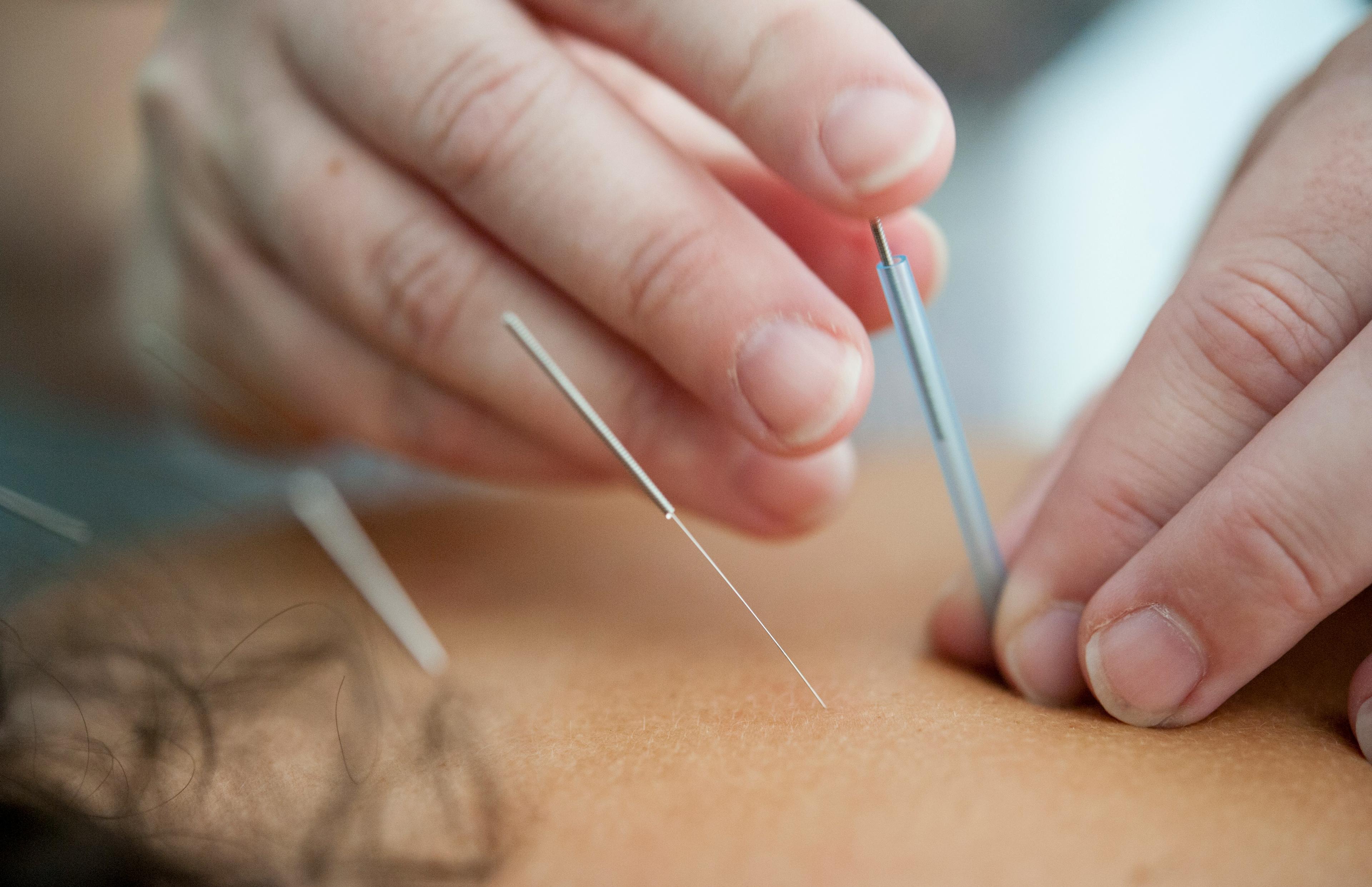 Acupuncture & TCM